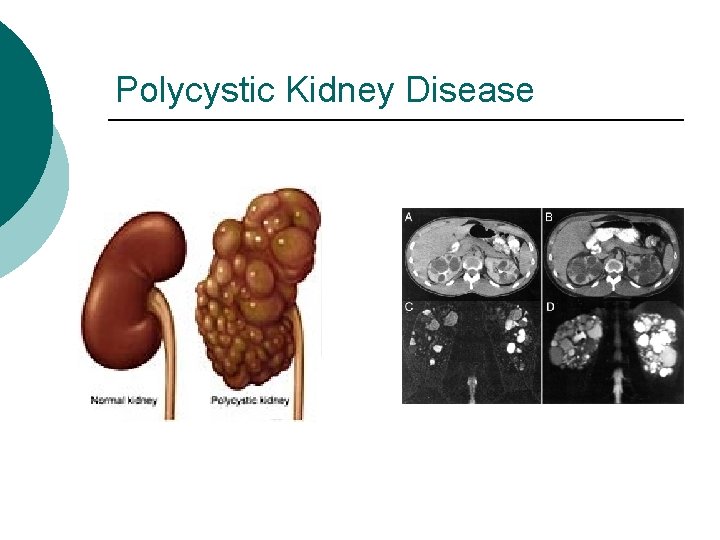 Polycystic Kidney Disease 