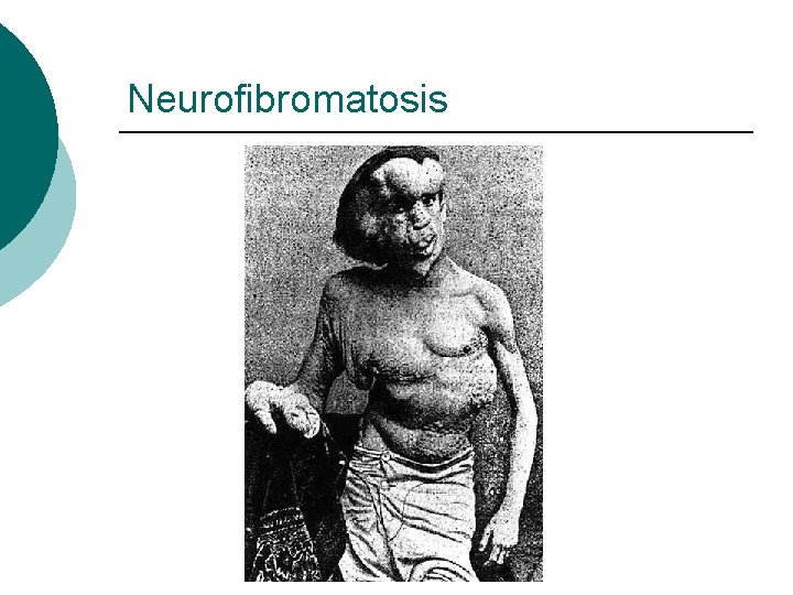 Neurofibromatosis 
