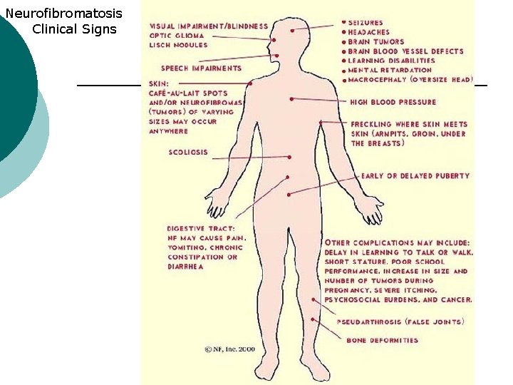 Neurofibromatosis Clinical Signs 