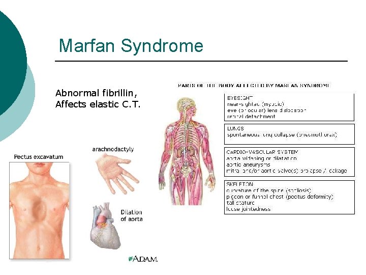 Marfan Syndrome Abnormal fibrillin, Affects elastic C. T. 