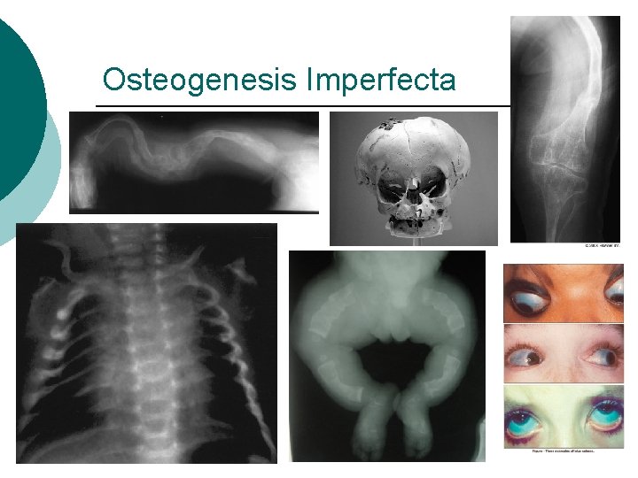 Osteogenesis Imperfecta 