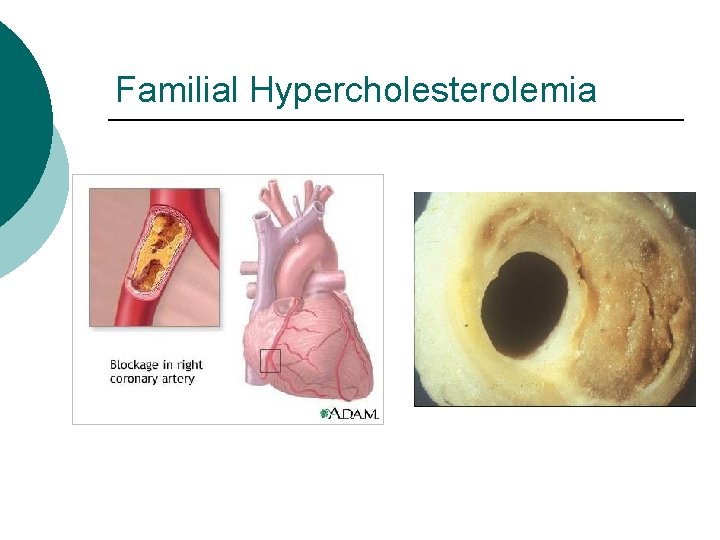 Familial Hypercholesterolemia 