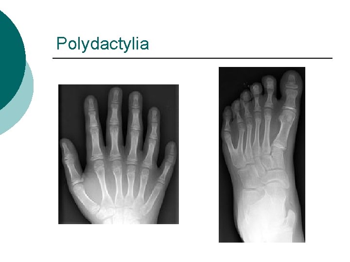 Polydactylia 