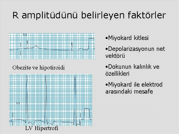 R amplitüdünü belirleyen faktörler • Miyokard kitlesi • Depolarizasyonun net vektörü Obezite ve hipotiroidi