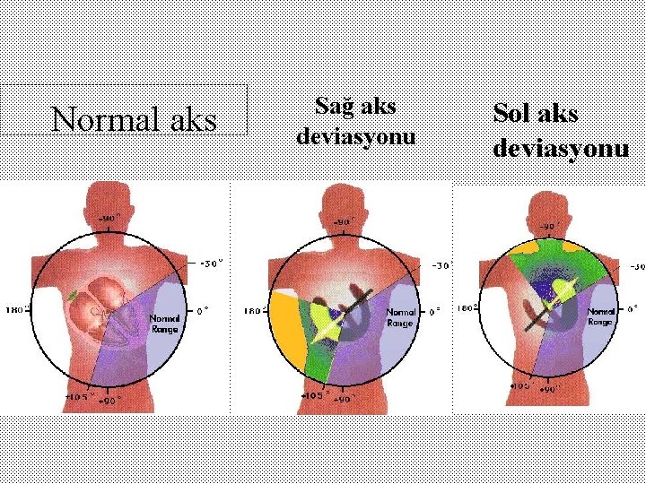 Normal aks Sağ aks deviasyonu Sol aks deviasyonu 