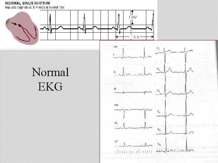 Normal EKG 