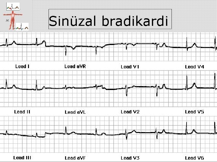 Sinüzal bradikardi 