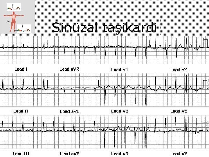 Sinüzal taşikardi 