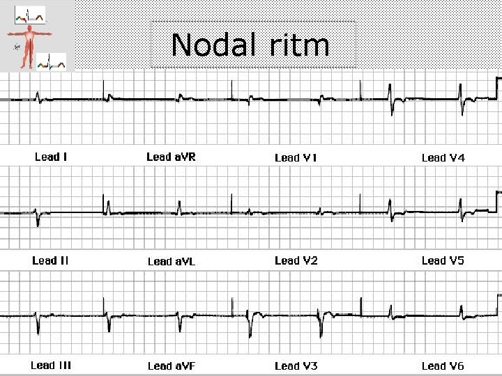 Nodal ritm 