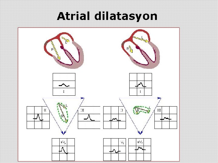 Atrial dilatasyon 