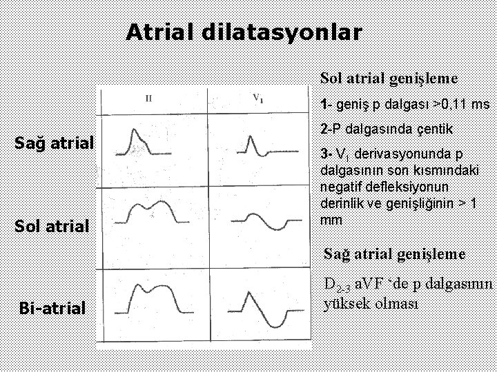 Atrial dilatasyonlar Sol atrial genişleme 1 - geniş p dalgası >0, 11 ms Sağ