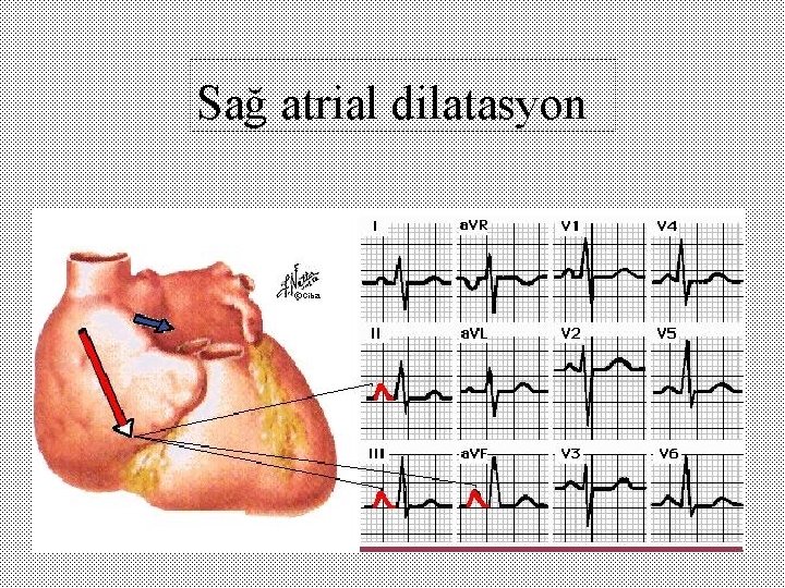 Sağ atrial dilatasyon 