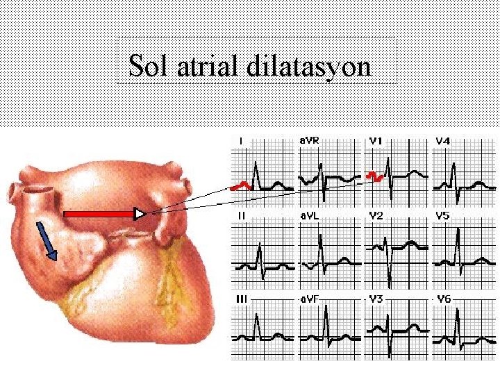 Sol atrial dilatasyon 