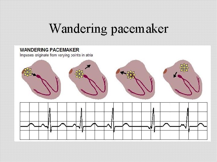 Wandering pacemaker 