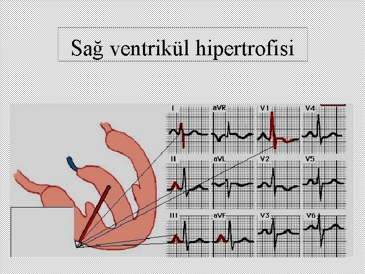 Sağ ventrikül hipertrofisi 