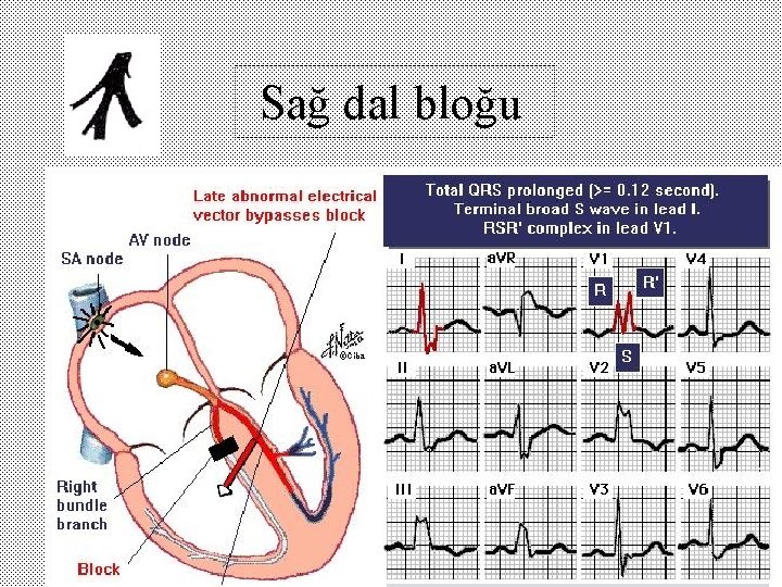 Sağ dal bloğu 