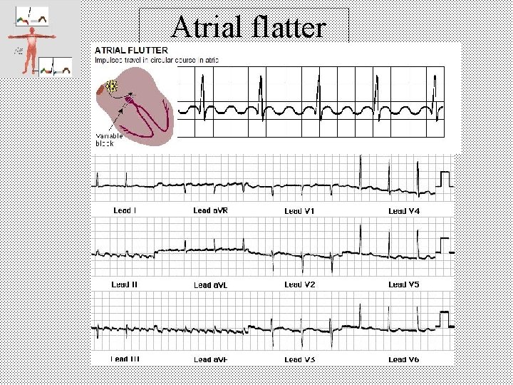 Atrial flatter 