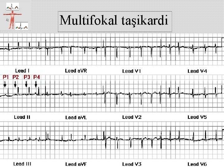 Multifokal taşikardi 