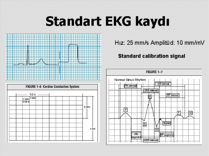 Standart EKG kaydı Hız: 25 mm/s Amplitüd: 10 mm/m. V Standard calibration signal 