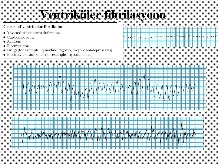 Ventriküler fibrilasyonu 