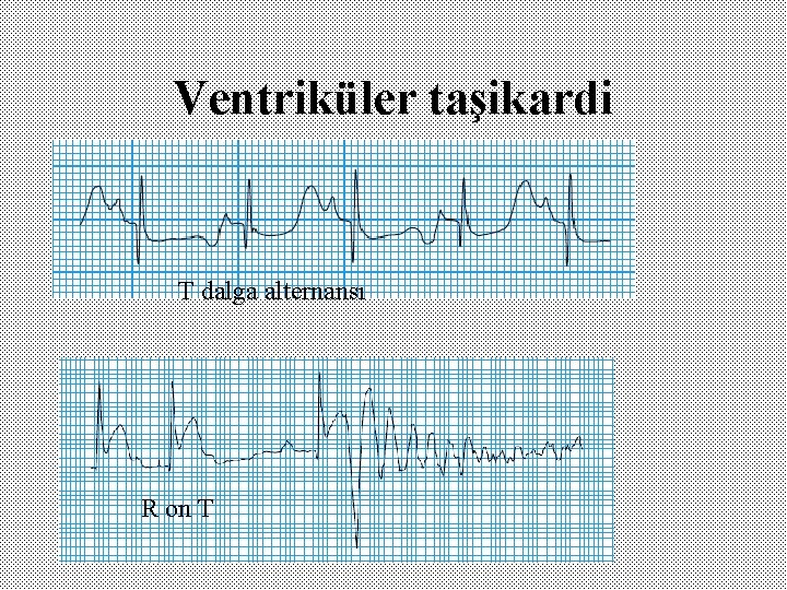 Ventriküler taşikardi T dalga alternansı R on T 