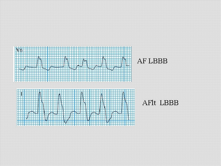 AF LBBB AFlt LBBB 