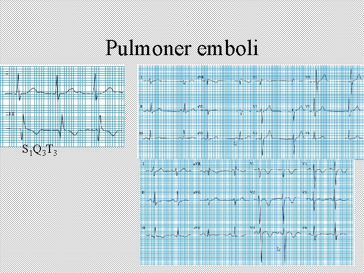 Pulmoner emboli S 1 Q 3 T 3 