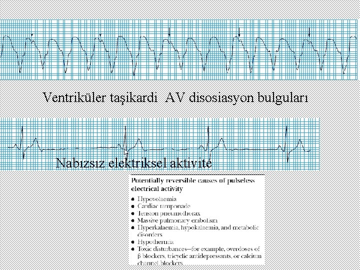 Ventriküler taşikardi AV disosiasyon bulguları Nabızsız elektriksel aktivite 