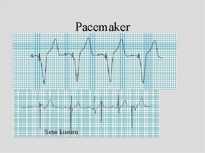 Pacemaker Sens kusuru 