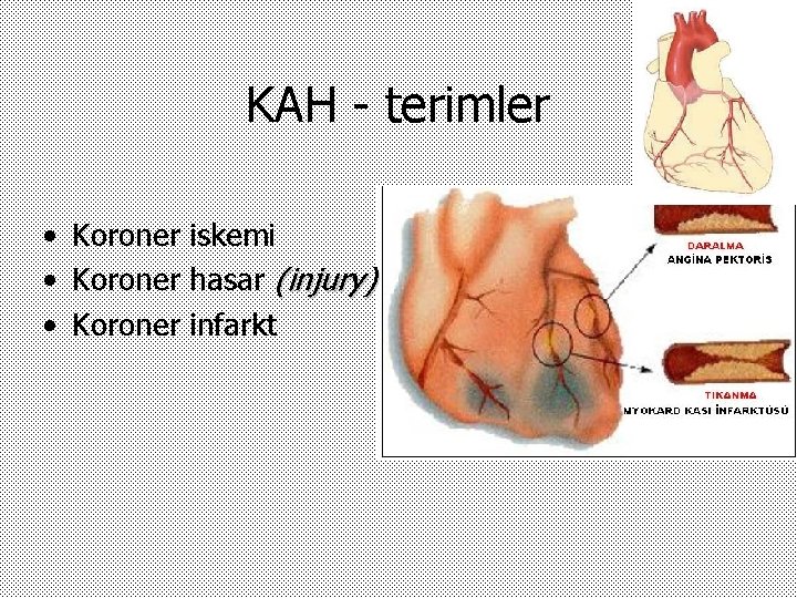 KAH - terimler • Koroner iskemi • Koroner hasar (injury) • Koroner infarkt 