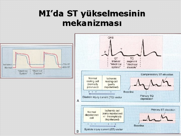 MI’da ST yükselmesinin mekanizması 