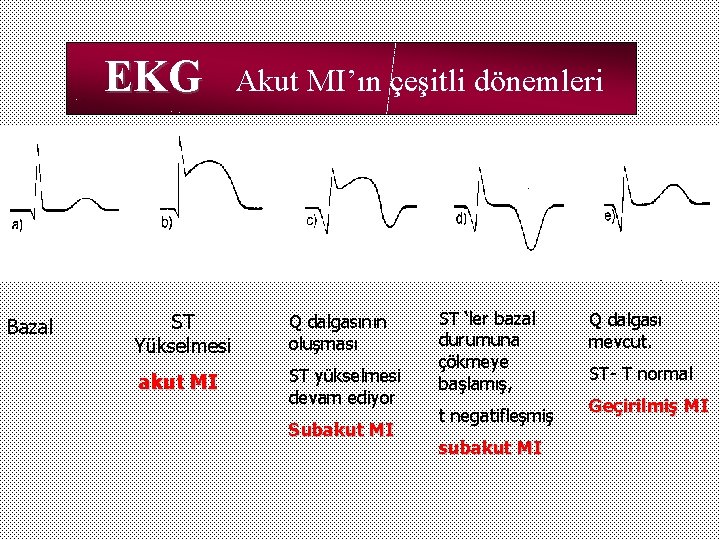 EKG Bazal Akut MI’ın çeşitli dönemleri ST Yükselmesi Q dalgasının oluşması akut MI ST