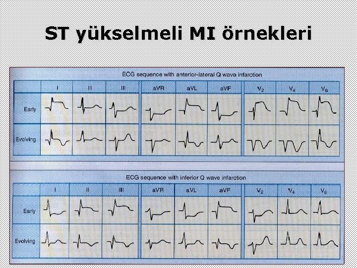 ST yükselmeli MI örnekleri 