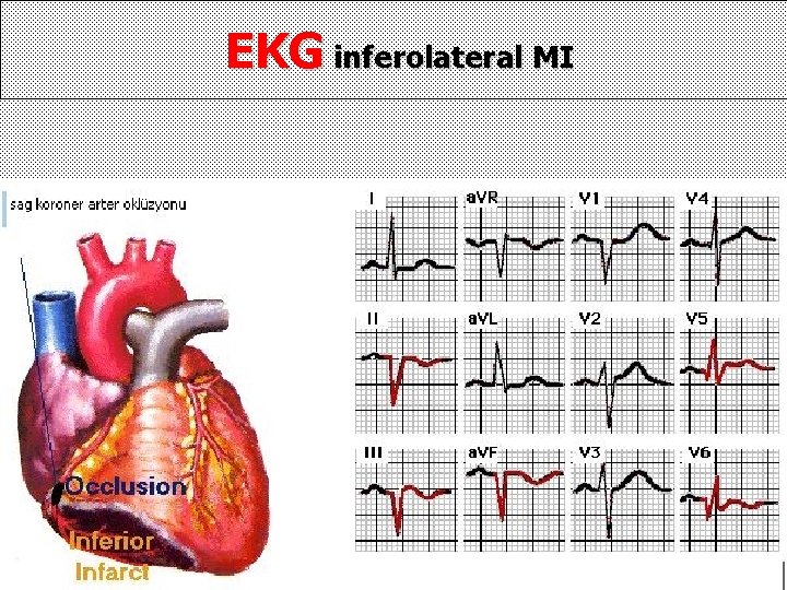 EKG inferolateral MI 