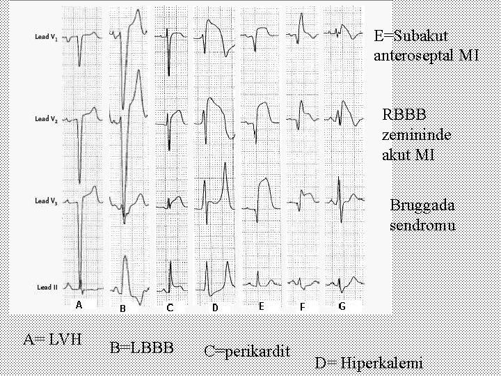 E=Subakut anteroseptal MI RBBB zemininde akut MI Bruggada sendromu A= LVH B=LBBB C=perikardit D=