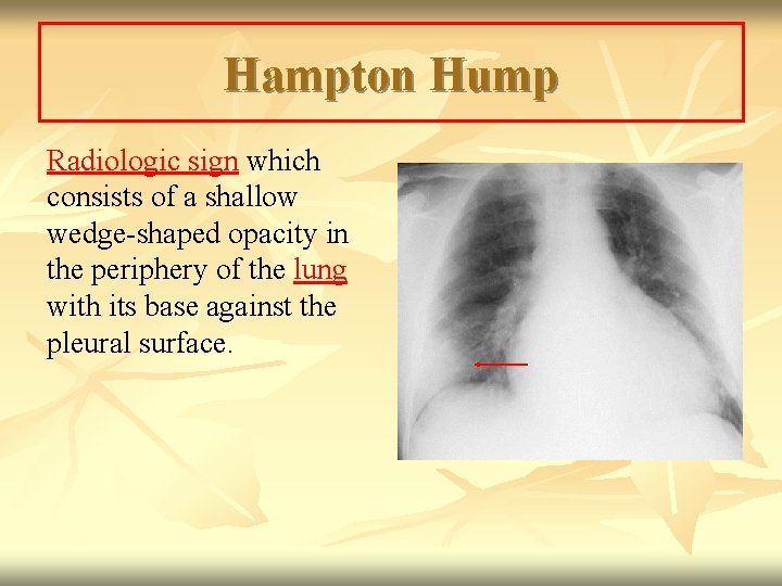 Hampton Hump Radiologic sign which consists of a shallow wedge-shaped opacity in the periphery