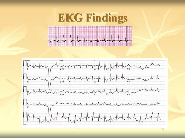 EKG Findings 