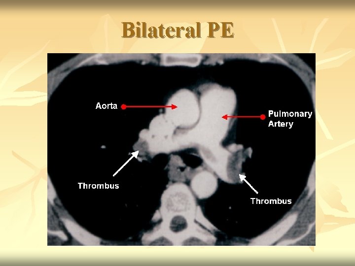 Bilateral PE 