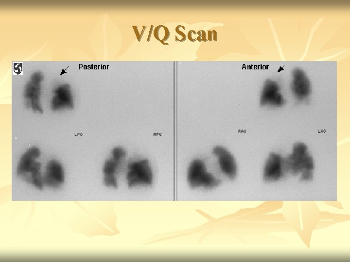 V/Q Scan 