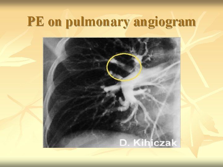 PE on pulmonary angiogram 