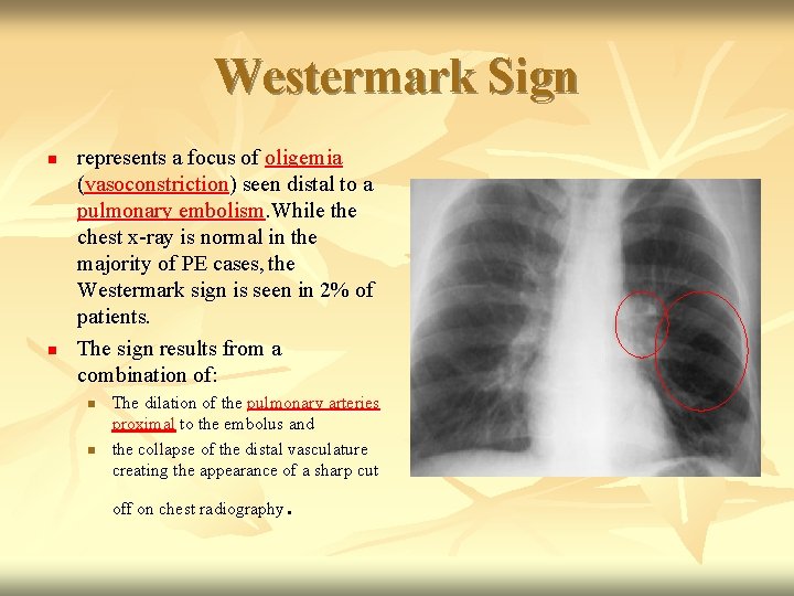 Westermark Sign n n represents a focus of oligemia (vasoconstriction) seen distal to a