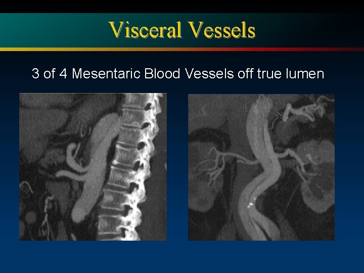 Visceral Vessels 3 of 4 Mesentaric Blood Vessels off true lumen 