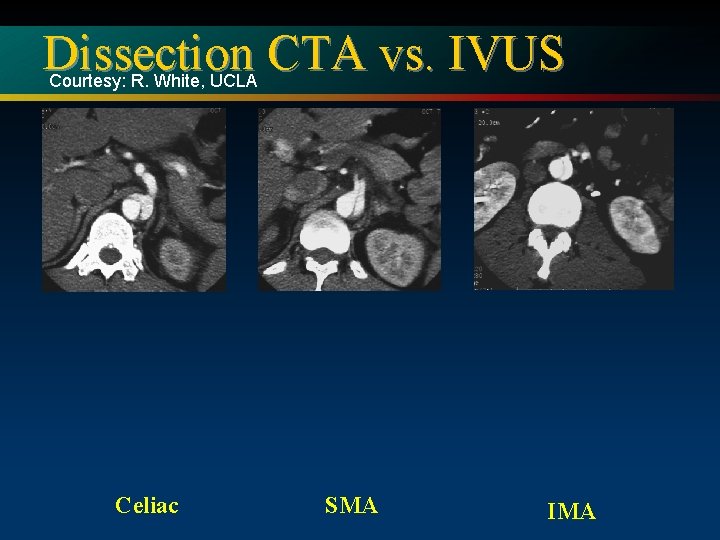 Dissection CTA vs. IVUS Courtesy: R. White, UCLA Celiac SMA IMA 