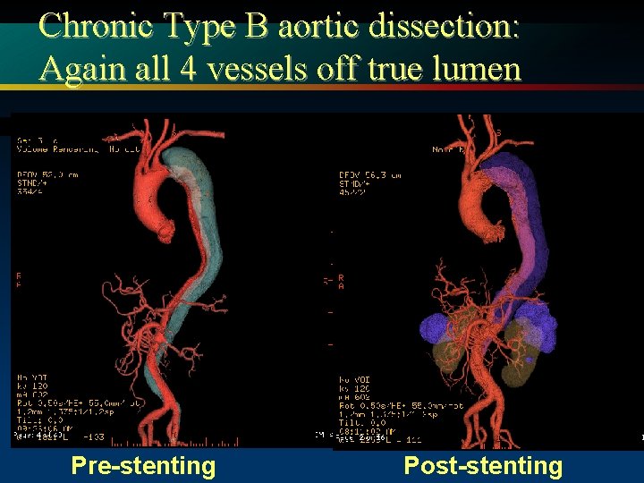 Chronic Type B aortic dissection: Again all 4 vessels off true lumen Pre-stenting Post-stenting