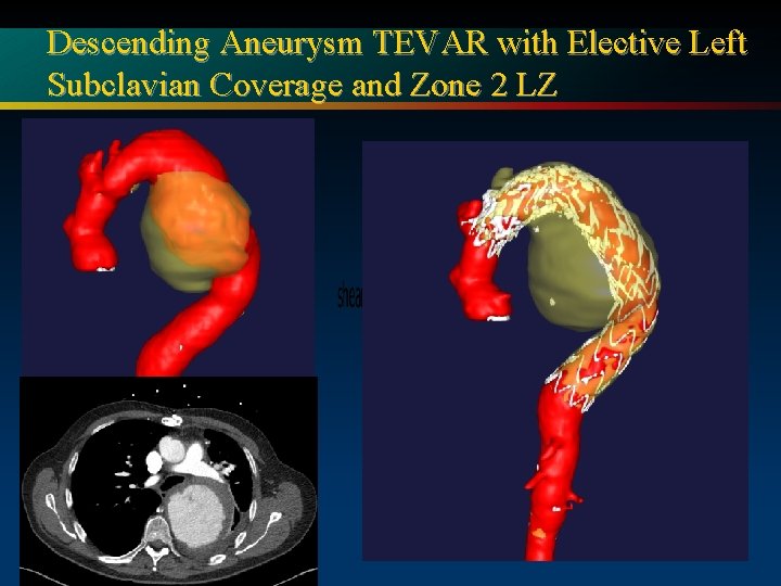 Descending Aneurysm TEVAR with Elective Left Subclavian Coverage and Zone 2 LZ 