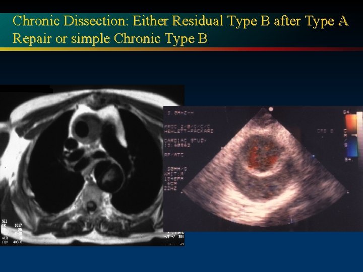 Chronic Dissection: Either Residual Type B after Type A Repair or simple Chronic Type