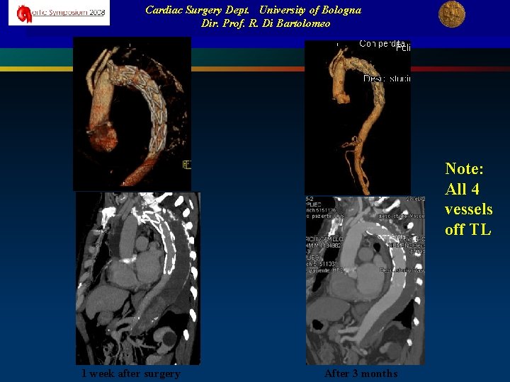 Cardiac Surgery Dept. University of Bologna Dir. Prof. R. Di Bartolomeo Note: All 4