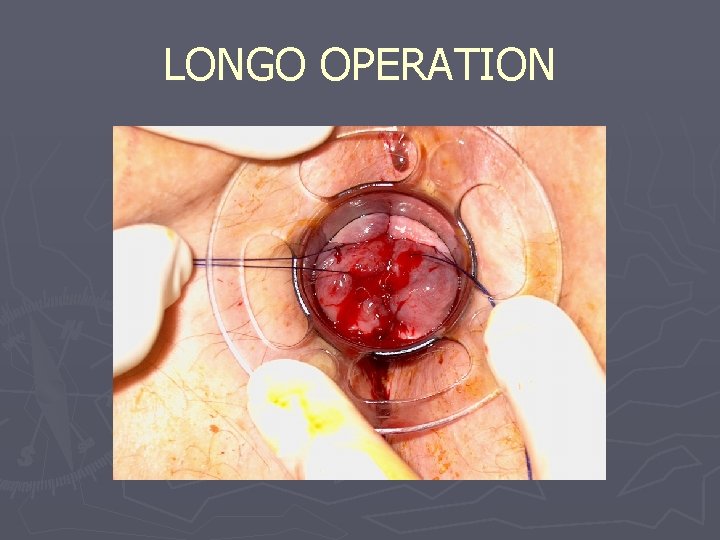 LONGO OPERATION 