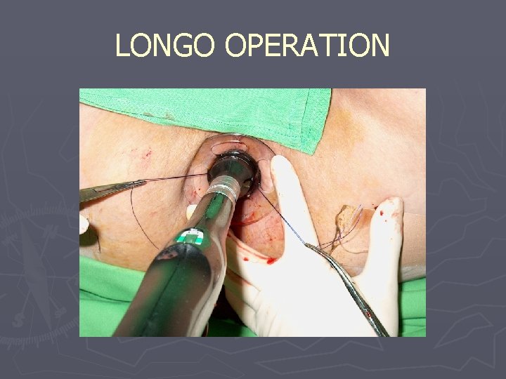 LONGO OPERATION 