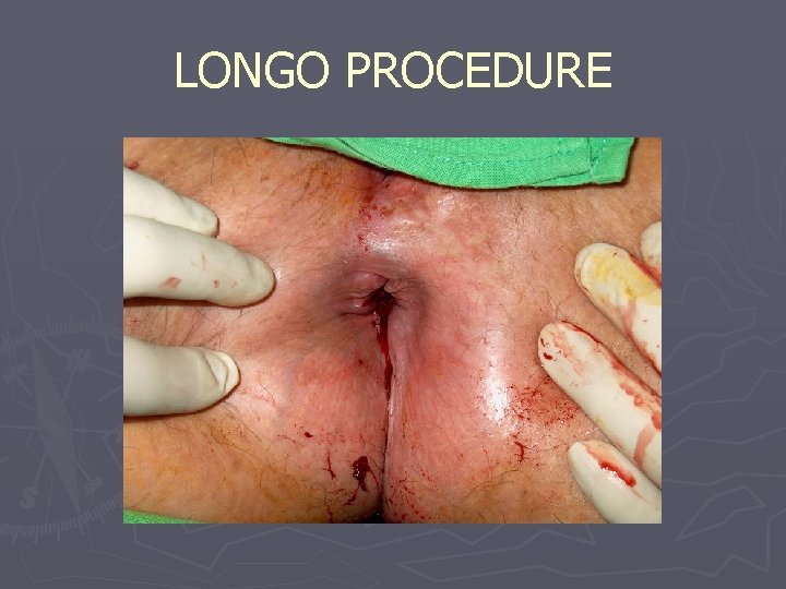 LONGO PROCEDURE 